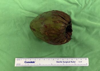 椰子研究讓義大醫院上國際期刊！高雄阿北求刺激異物塞進肛門