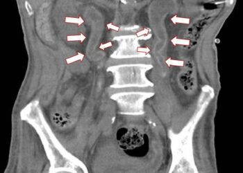 影音/結石不成塊滿覆蓋泌尿道　醫師：多喝水 不要憋尿 適度運動