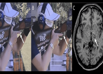職業手抽筋還能救嗎?　秀傳醫薩刀解決顫抖症困擾多年疾病