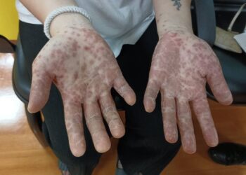 大人也會染上腸病毒不要輕忽　小心嚴重者出現密密麻麻的紅疹怵目驚心