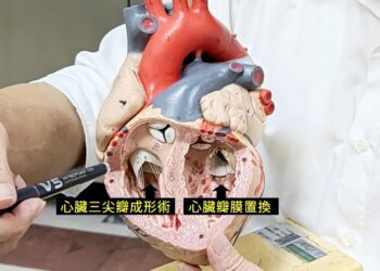 東港安泰醫院複合性心臟手術 助86歲阿嬤成功延壽