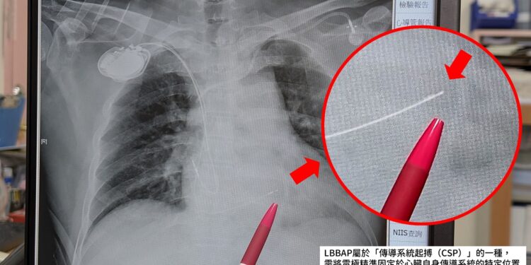 67歲男急性心肌梗塞合併嚴重傳導阻滯　安泰醫院完成LBBAP治療康復出院