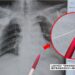 67歲男急性心肌梗塞合併嚴重傳導阻滯　安泰醫院完成LBBAP治療康復出院