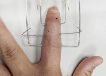 滑不動！手指受傷無法滑手機 博愛醫師特製手指固定器助復健