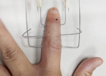 滑不動！手指受傷無法滑手機　博愛醫師特製手指固定器助復健