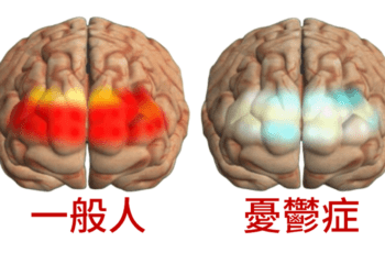 憂鬱症評估與治療新利器　結合近紅外光腦光譜檢測、顱刺激治療效果看得見