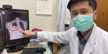 男子低血糖反覆發作竟非糖尿病 多次昏迷送醫揪出25公分罕見肺腫瘤