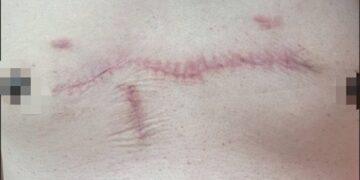 男青春痘捏破異常增生變成「大蜈蚣」 員榮整形妙手以羊膜因子改善蟹足腫