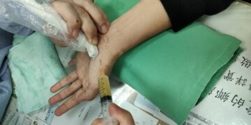 腕隧道手術後反而夜夜痛醒 超音波揪出神經沾黏