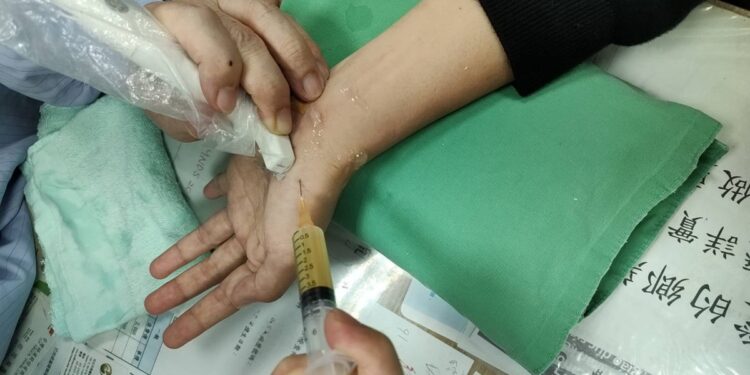 腕隧道手術後反而夜夜痛醒 超音波揪出神經沾黏