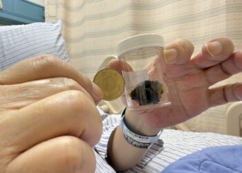 3公分膽結石沒事 0.5公分總膽管結石竟爆致命危機
