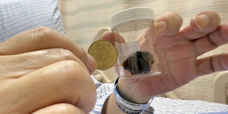 3公分膽結石沒事 0.5公分總膽管結石竟爆致命危機
