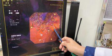 罹癌婦人發燒、噁心送急診 醫師發現因膽管道塑膠支架阻塞引起