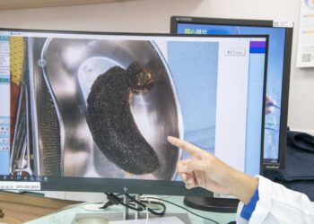 影音/8歲女童吞髮導致毛結石　彰基兒醫團隊呼籲關注兒童心理健康