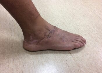 男子出車禍足踝被削平！ 醫師馬拉松精準接合恢復足功能