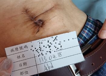 影音／員榮與仁愛長庚攜手　解決腹部切口疝氣手術患者一直流膿惱人問題