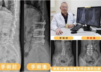 側開式腰椎微創手術　治癒八旬嬤背痛與駝背