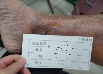 足踝傷口潰爛十多年 求診員榮醫師解決長年困擾