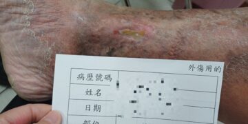 足踝傷口潰爛十多年 求診員榮醫師解決長年困擾