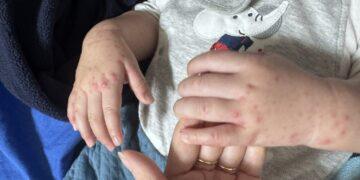 隱匿疫情恐觸法　高雄雙語小學腸病毒事件家長籲徹查