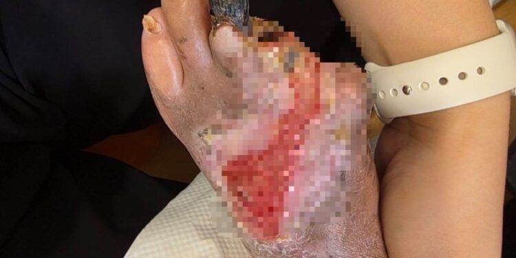 婦剪趾甲竟變截掉兩根腳趾 經歷清創靠中醫雷射針灸重新站起來